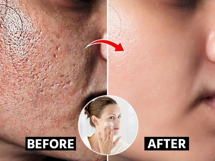 skincare tips, home remedies, open pores on the face - Does the face look rough? 4 easy remedies to reduce open pores | चेहऱ्यावर लहान छिद्र-चेहरा खडबडीत दिसतो? गालावरचे ओपन पोर्स कमी करणारे ४ सोपे उपाय