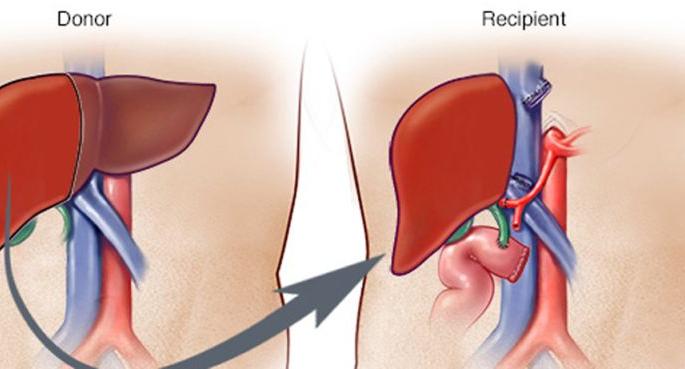 31 liver transplants in 18 months in Nagpur | नागपुरात १८ महिन्यात ३१ यकृत प्रत्यारोपण 31 liver transplants in 18 months in Nagpur | नागपुरात १८ महिन्यात ३१ यकृत प्रत्यारोपण