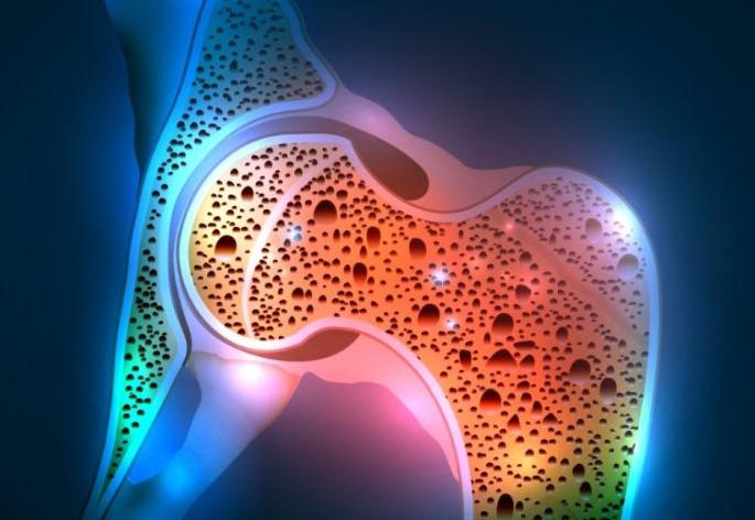 Bone thickening increases the risk of 'osteoporosis'! | हाडांच्या ठिसुळतेमुळे वाढतोय ‘आॅस्टियोपोरोसिस’चा धोका! Bone thickening increases the risk of 'osteoporosis'! | हाडांच्या ठिसुळतेमुळे वाढतोय ‘आॅस्टियोपोरोसिस’चा धोका!