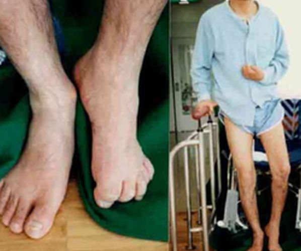 In Mayo, Medical Paralysis Patients Increased | मेयो, मेडिकलमध्ये वाढले पक्षाघाताचे रुग्ण In Mayo, Medical Paralysis Patients Increased | मेयो, मेडिकलमध्ये वाढले पक्षाघाताचे रुग्ण