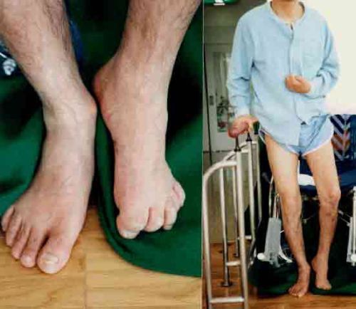 Paralysis patients increase in medical college hospital | मेडिकल कॉलेज इस्पितळात पक्षाघाताच्या रुग्णांत वाढ