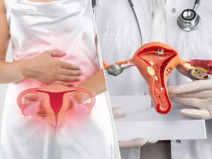 PCOS Name Changed To PMOS: How This Impacts Women Globally And In India | PCOS नाही, आता PMOS! ८ पैकी १ ‘या’ समस्येने त्रस्त; १७ कोटी महिलांच्या आरोग्यावर थेट परिणाम PCOS Name Changed To PMOS: How This Impacts Women Globally And In India | PCOS नाही, आता PMOS! ८ पैकी १ ‘या’ समस्येने त्रस्त; १७ कोटी महिलांच्या आरोग्यावर थेट परिणाम