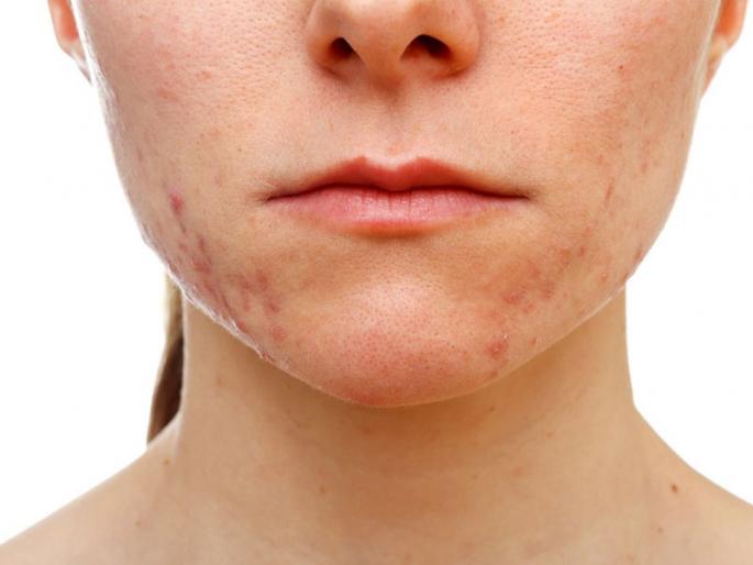 symptoms and treatment of polycystic ovary syndrome | Polycystic Ovarian Syndrome : महिलांनो, वेळीच ओळखा या सिंड्रोमची लक्षणं! symptoms and treatment of polycystic ovary syndrome | Polycystic Ovarian Syndrome : महिलांनो, वेळीच ओळखा या सिंड्रोमची लक्षणं!