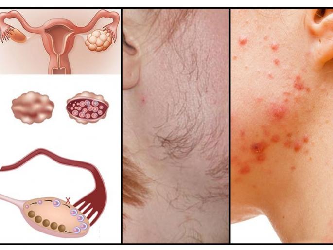 PCOS Treatment in Ayurveda and Yoga | आयुर्वेद आणि योगची गुंफण, सोपे होईल PCOSचे नियंत्रण PCOS Treatment in Ayurveda and Yoga | आयुर्वेद आणि योगची गुंफण, सोपे होईल PCOSचे नियंत्रण