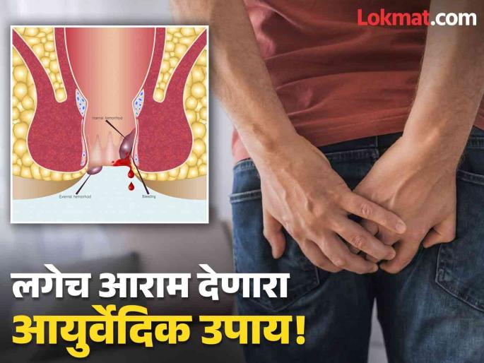 Doctor told a effective home remedies to treat piles or bawasir at home | पाइल्सची समस्या दूर करणारा सोपा आयुर्वेदिक उपाय, जाणून घ्या कसा कराल वापर! Doctor told a effective home remedies to treat piles or bawasir at home | पाइल्सची समस्या दूर करणारा सोपा आयुर्वेदिक उपाय, जाणून घ्या कसा कराल वापर!