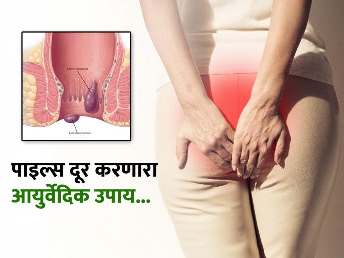 Ayurveda doctor tells home remedies to get rid off piles naturally | नाजूक जागेच्या दुखण्यानं झालात हैराण? लगेच करा पाइल्स बरा करणारा 'हा' नॅचरल उपाय...