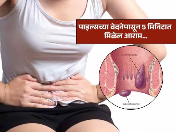 Doctor tells how to get relief from piles pain in 5 minutes hemorrhoid pain | पाइल्सचा त्रास-प्रचंड वेदना होतात? डॉक्टर सांगतात ‘असा’ उपाय करा, ५ मिनिटांत वेदना होतील कमी