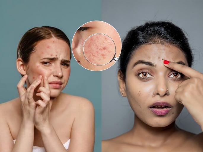 Popping a pimple increases the pain, home remedies to reduce pimple scars, see how to manage pimple problem | पिकलेले ठणकणारे मोठे पिंपल फोडल्यावर आणखी वाढतो त्रास, डाग कमी करणारा घरगुती उपाय