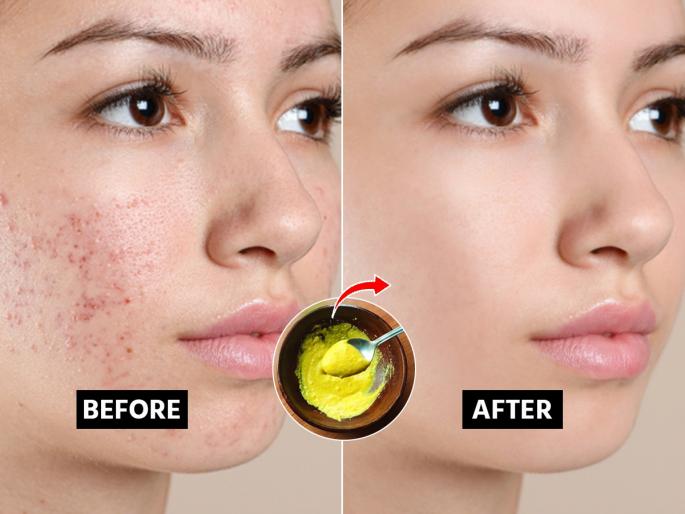 How to get glowing skin using besan : Gram Flour Benefits Besan Face Pack Recipes For All Skin Types | काळ्या डागांनी चेहरा खराब झालाय? किचनमधला १ पदार्थ, चेहरा होईल नितळ-डाग कमी
