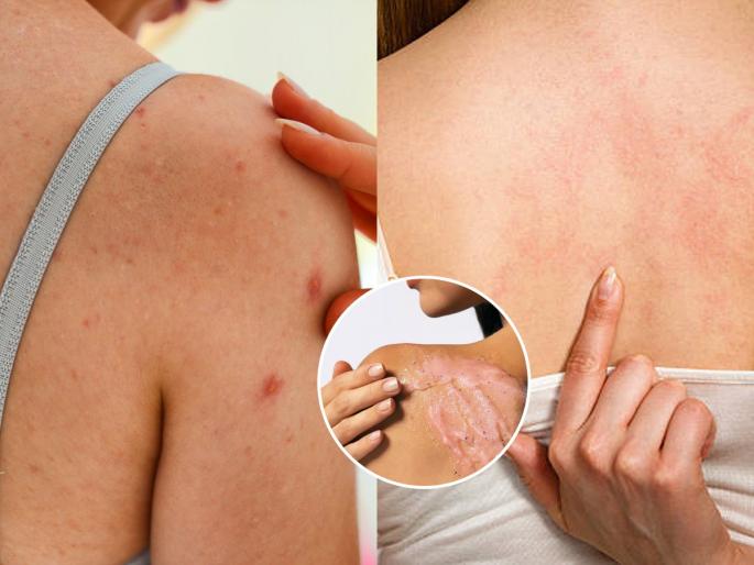 how to reduce acne and pimples on back, simple trick and home remedies to get rid of acne and pimples on back | पाठीवर सारखे फोडं, पुरळ येऊन त्यांना खाज येते?  बघा त्यामागची कारणं आणि ३ सोपे उपाय 
