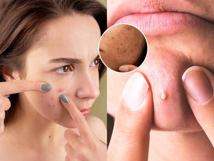 What happens if you pop a pimple? These changes occur in the skin for a lifetime | काय विचारता, पिंपल्स फोडले तर काय होतं? त्वचेत आयुष्यभरासाठी होतात ‘हे’ बदल, एक पिंपल पडतो महागात