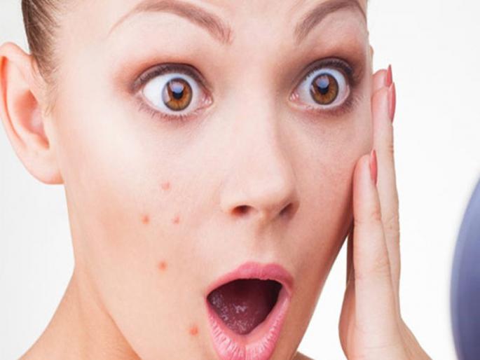 Fashion and beauty tips how to use onion for acne pimples | चेहऱ्यावरील पिंपल्समुळे त्रस्त आहात?; कांदा करेल मदत Fashion and beauty tips how to use onion for acne pimples | चेहऱ्यावरील पिंपल्समुळे त्रस्त आहात?; कांदा करेल मदत