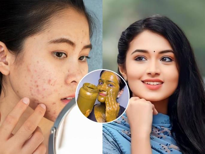 How to use gram flour for pimples and glowing skin Best natural face pack for dull skin and acne | चेहऱ्यावर भरमसाठ पिंपल्स- निस्तेजही दिसतो? बेसनाच्या पिठात कालवून १ पदार्थ लावा, आठवड्याभरात चेहऱ्यावर येईल ग्लो