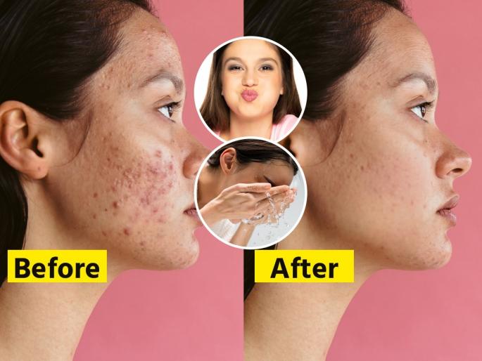 How to get rid of pimples naturally at home Simple skincare tip for acne and glow Natural glow for acne-prone skin | चेहऱ्यावरील पिंपल्स- फोडांनी त्रस्त? महागड्या क्रीम्स नकोच! १ सोपी ट्रिक,चेहऱ्यावर येईल ग्लो- मुरुमांचा त्रासही कमी..
