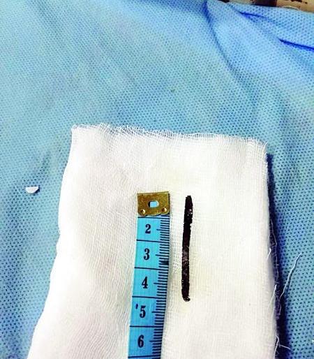 Four months ago, engulp pin took out | चार महिन्यांपूर्वी गिळलेली पीन काढली बाहेर Four months ago, engulp pin took out | चार महिन्यांपूर्वी गिळलेली पीन काढली बाहेर