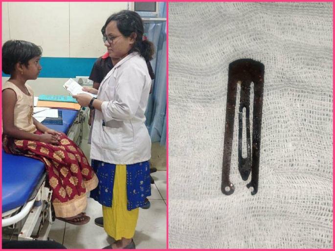 pin stuck in the abdomen was surgically removed of Swati netare sasoon hospital | आता स्वाती घेणार मोकळा श्वास...! पोटात अडलकलेली पिन शस्त्रक्रियेद्वारे काढली pin stuck in the abdomen was surgically removed of Swati netare sasoon hospital | आता स्वाती घेणार मोकळा श्वास...! पोटात अडलकलेली पिन शस्त्रक्रियेद्वारे काढली