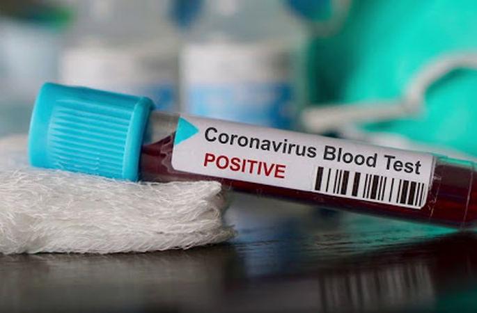 Another 248 corona positive in Akola district | अकोला जिल्ह्यात आणखी २४८ कोरोना पॉझिटिव्ह Another 248 corona positive in Akola district | अकोला जिल्ह्यात आणखी २४८ कोरोना पॉझिटिव्ह