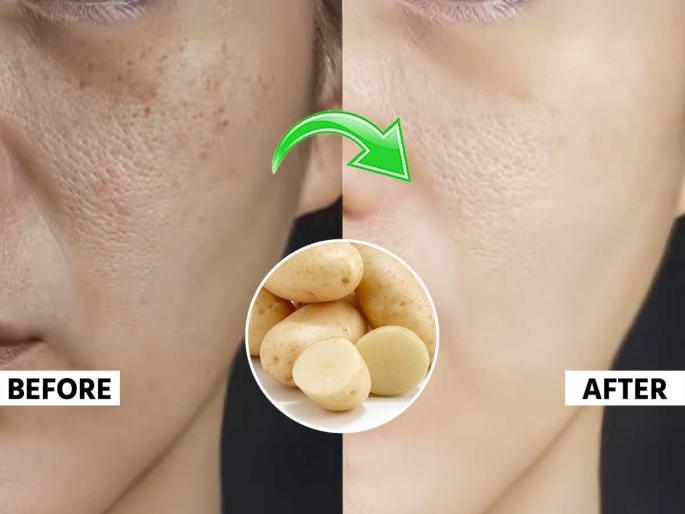 how to use potato juice to remove pigmentation and dark circles best natural remedy for tanning and uneven skin tone DIY face mask with potato juice for glowing skin | पिग्मेंटेशन, डोळ्याभोवती काळी वर्तुळे- चेहरा टॅन? बटाट्याच्या रसात मिसळा ३ पदार्थ, चेहऱ्यावरचे वांग-काळे डाग होतील कमी how to use potato juice to remove pigmentation and dark circles best natural remedy for tanning and uneven skin tone DIY face mask with potato juice for glowing skin | पिग्मेंटेशन, डोळ्याभोवती काळी वर्तुळे- चेहरा टॅन? बटाट्याच्या रसात मिसळा ३ पदार्थ, चेहऱ्यावरचे वांग-काळे डाग होतील कमी