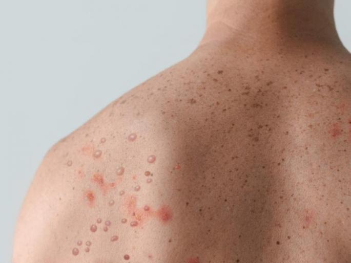 Samples of ten suspected monkey pox patients from the state were sent to NIV for examination | Monkey Pox: राज्यातून मंकी पॉक्सच्या दहा संशयित रुग्णांचे नमुने एनआयव्ही कडे तपासणीला Samples of ten suspected monkey pox patients from the state were sent to NIV for examination | Monkey Pox: राज्यातून मंकी पॉक्सच्या दहा संशयित रुग्णांचे नमुने एनआयव्ही कडे तपासणीला