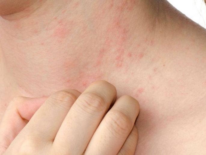 Summer special expert tips to deal with prickly heat | उन्हाळयात घामोळ्यांपासून बचावासाठी खास टिप्स Summer special expert tips to deal with prickly heat | उन्हाळयात घामोळ्यांपासून बचावासाठी खास टिप्स