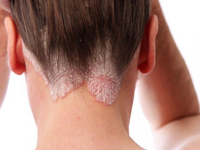 Psoriasis problem increases in winter 7 tips will keep you safe | थंडीमध्ये वाढते सोरायसिसची समस्या; दुर्लक्ष करणं पडू शकतं महागात Psoriasis problem increases in winter 7 tips will keep you safe | थंडीमध्ये वाढते सोरायसिसची समस्या; दुर्लक्ष करणं पडू शकतं महागात