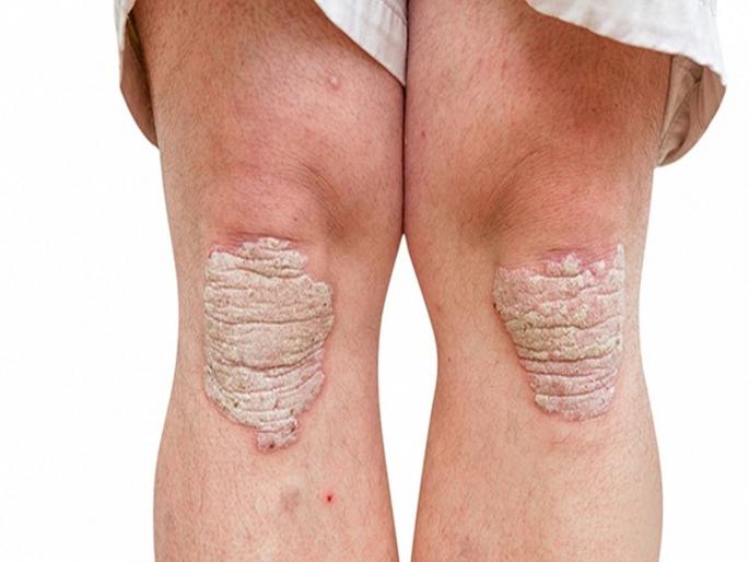 Early signs and symptoms of psoriasis causes risk factors medial treatment home remedies foods | सोरायसिस होण्याआधी शरीरामध्ये होतात हे बदल; जाणून घ्या लक्षणं आणि उपाय Early signs and symptoms of psoriasis causes risk factors medial treatment home remedies foods | सोरायसिस होण्याआधी शरीरामध्ये होतात हे बदल; जाणून घ्या लक्षणं आणि उपाय