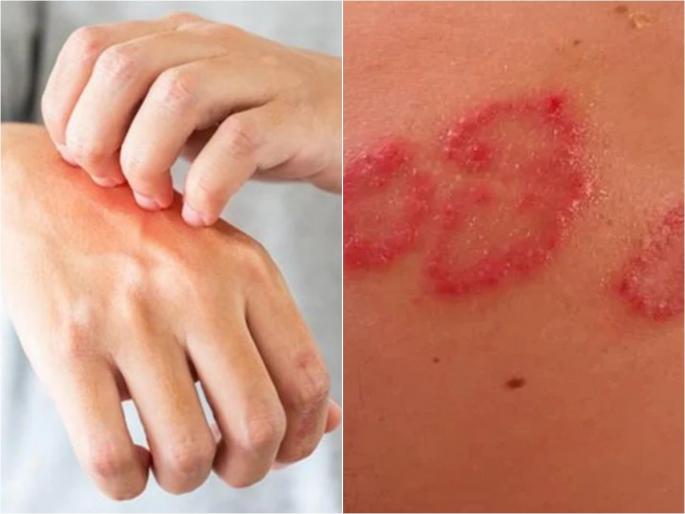 Corona virus omicron symptoms in india skin problem precaution expert opinion | Omicron Symptom : फक्त स्किनवरच दिसतं ओमिक्रॉनचं 'हे' विचित्र लक्षण, दिसताक्षणी व्हा सावध! Corona virus omicron symptoms in india skin problem precaution expert opinion | Omicron Symptom : फक्त स्किनवरच दिसतं ओमिक्रॉनचं 'हे' विचित्र लक्षण, दिसताक्षणी व्हा सावध!