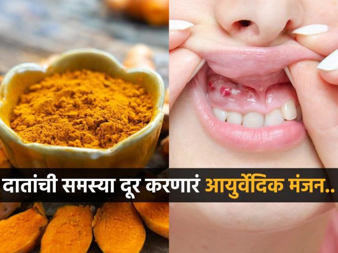 How to make ayurvedic toothpaste to treat pyorrhea | हिरड्यांना सूज-रक्तही येतं, हा आजार म्हणजे पायरिया; वापरा ‘हे’ घरगुती आयुर्वेदिक मंजन