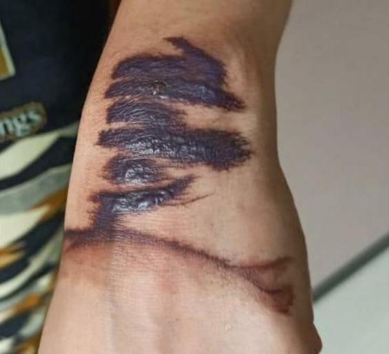 Quarantine stamps cause wounds on the hands | क्वारंटाईन स्टॅम्पमुळे हातावर होताहेत जखमा Quarantine stamps cause wounds on the hands | क्वारंटाईन स्टॅम्पमुळे हातावर होताहेत जखमा