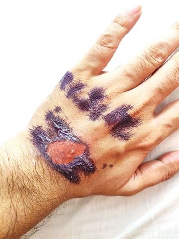 The skin of the train passenger was also peeled off due to the 'stamp' | रेल्वे प्रवाशाचीही ‘स्टॅम्प’मुळे त्वचा सोलून निघाली