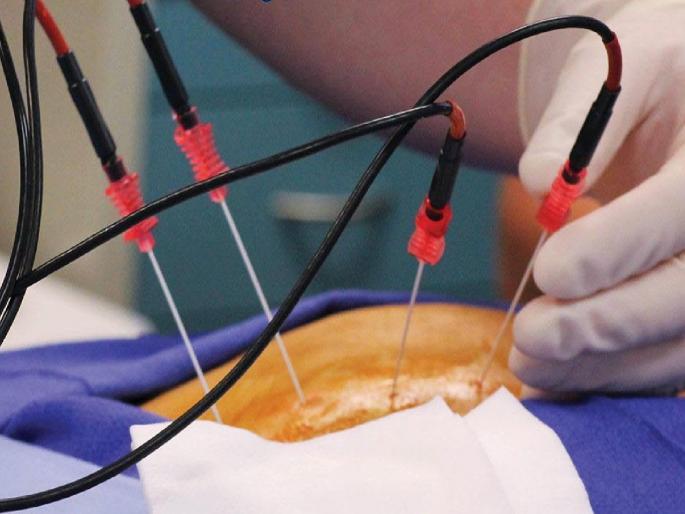 Pain like 'shock' is removed with 'radio frequency ablation'; Pain management treatments are beneficial | ‘शाॅक’सारख्या वेदना ‘रेडिओ फ्रिक्वेन्सी ॲब्लेशन’ने दूर; पेन मॅनेजमेंट उपचार पद्धती फायद्याची