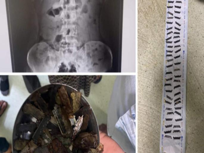 Man swallow 56 razor blades doctors remove after immediate surgery in Rajasthan | एक-एक करून तरूणाने गिळले 56 ब्लेड, एक्स-रे पाहून डॉक्टरही झाले हैराण Man swallow 56 razor blades doctors remove after immediate surgery in Rajasthan | एक-एक करून तरूणाने गिळले 56 ब्लेड, एक्स-रे पाहून डॉक्टरही झाले हैराण