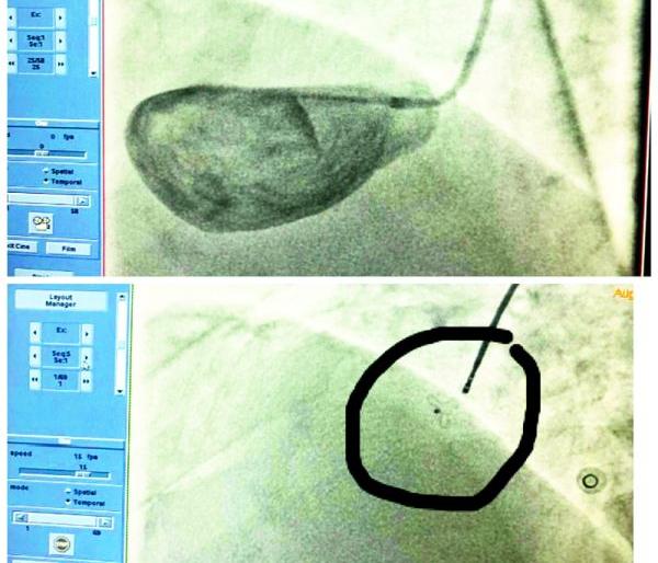 At the world's rare surgical in super specialty hospital | जगातील दुर्मिळ शस्त्रक्रिया सुपर स्पेशालिटी हॉस्पिटलमध्ये