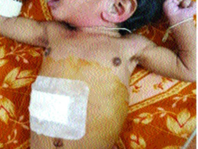 One-month-old baby's small intestinal surgery successful | एक महिन्याच्या बाळाच्या छोट्या आतड्यावरील शस्त्रक्रिया यशस्वी One-month-old baby's small intestinal surgery successful | एक महिन्याच्या बाळाच्या छोट्या आतड्यावरील शस्त्रक्रिया यशस्वी
