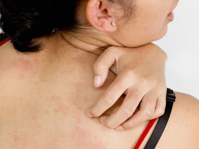 Will rashes really end up showing the light | एका विशेष लाइटच्या प्रकाशाने दूर होईल खाजेची समस्या? Will rashes really end up showing the light | एका विशेष लाइटच्या प्रकाशाने दूर होईल खाजेची समस्या?