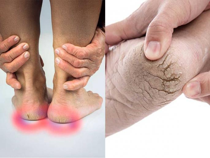 main reason and causes of cracked heel, deficiency of which vitamin causes cracked heel | तळपायांना सतत भेगा? क्रिम चोपडणं सोडा आणि हे पदार्थ खा, बघा भेगांमागचं खरं कारण main reason and causes of cracked heel, deficiency of which vitamin causes cracked heel | तळपायांना सतत भेगा? क्रिम चोपडणं सोडा आणि हे पदार्थ खा, बघा भेगांमागचं खरं कारण