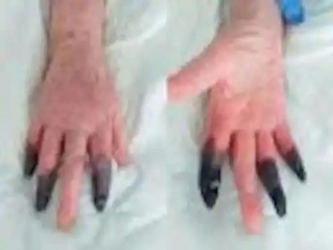 CoronaVirus News: Covid-19 positive woman doctors amputate 3 fingures | चिंताजनक! समोर आलं कोरोनाचं नवं लक्षण; कोरोना रुग्णाची बोटं काळी पडल्यानं कापावी लागली