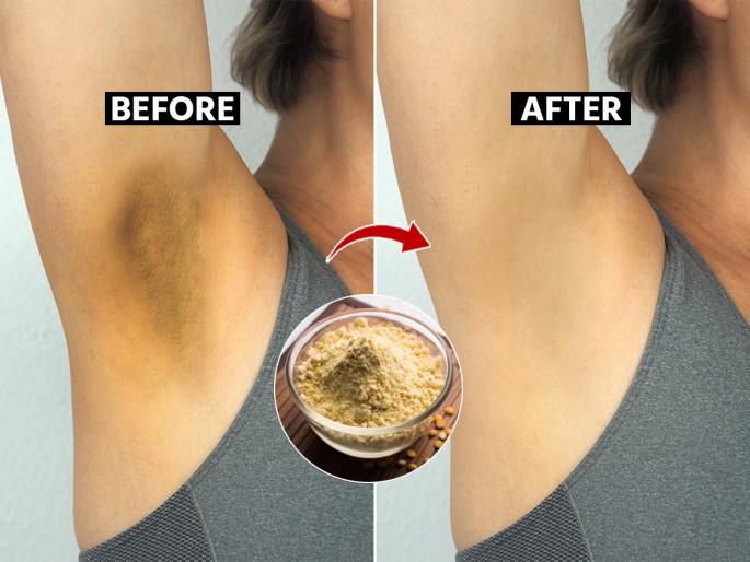 remedy to remove underarm blackness how to get rid of dark underarms natural remedies for dark underarms home remedies for underarm whitening : underarm darkness treatment at home | अंडरआर्म्स खूप काळेकुट्ट झालेत? स्वयंपाक घरातील ४ पदार्थ लावा, काळपटपणा होईल कमी...