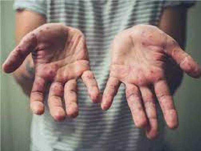 Reports of two people have come positive for measles in Akola | अकोल्यात गोवरची दस्तक; दोघांचे अहवाल पॉझिटीव्ह!  Reports of two people have come positive for measles in Akola | अकोल्यात गोवरची दस्तक; दोघांचे अहवाल पॉझिटीव्ह!