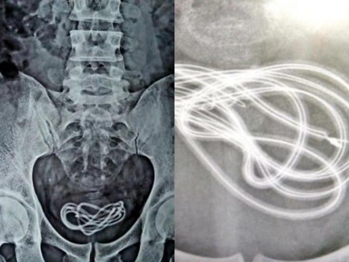 OMG! Assam man complained of stomach ache had charger cable in his bladder | बाबो! पोटात दुखत होतं म्हणून दवाखान्यात गेला, डॉक्टरांनी एक्स-रे पाहिला तर मूत्राशयात होता चार्जरचा केबल! OMG! Assam man complained of stomach ache had charger cable in his bladder | बाबो! पोटात दुखत होतं म्हणून दवाखान्यात गेला, डॉक्टरांनी एक्स-रे पाहिला तर मूत्राशयात होता चार्जरचा केबल!