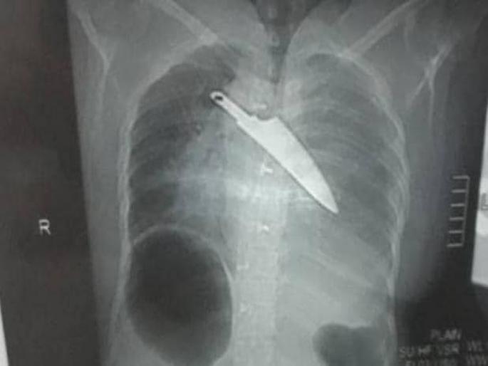 Knife removed from woman chest 30 hours after stabbing krishnagiri Tamil Nadu | कमाल! हल्ल्याच्या 30 तासांनंतर मल्लिकाच्या शरीरातून डॉक्टरांनी काढला चाकू, तब्बल 3 तास चालली सर्जरी Knife removed from woman chest 30 hours after stabbing krishnagiri Tamil Nadu | कमाल! हल्ल्याच्या 30 तासांनंतर मल्लिकाच्या शरीरातून डॉक्टरांनी काढला चाकू, तब्बल 3 तास चालली सर्जरी