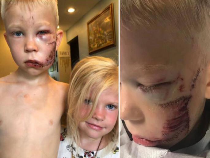 This brave 6 year old boy bridger walker who saved is sister from dog attack | शाब्बास रे पठ्ठ्या! ६ वर्षीय भावाने कुत्र्यापासून बहिणीला वाचवले, जखमी इतका झाला की ९० टाके पडले... This brave 6 year old boy bridger walker who saved is sister from dog attack | शाब्बास रे पठ्ठ्या! ६ वर्षीय भावाने कुत्र्यापासून बहिणीला वाचवले, जखमी इतका झाला की ९० टाके पडले...