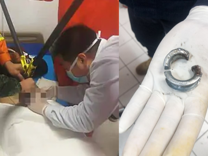 Thai man stuck ring on his penis on valentine day to impress girlfriend landed in hospital | बोंबला! गर्लफ्रेंडला खूश करण्यासाठी नको तो प्रयोग केला; थेट हॉस्पिटलात जाऊन पोहोचला! Thai man stuck ring on his penis on valentine day to impress girlfriend landed in hospital | बोंबला! गर्लफ्रेंडला खूश करण्यासाठी नको तो प्रयोग केला; थेट हॉस्पिटलात जाऊन पोहोचला!