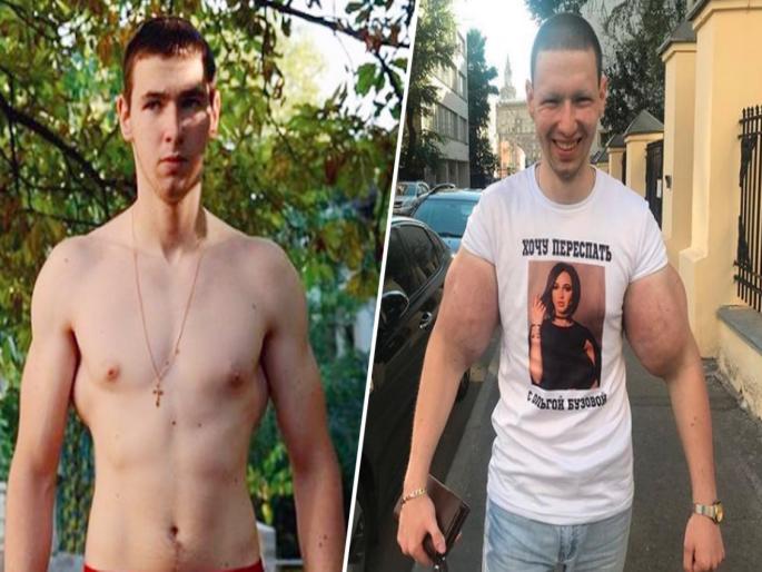 Russian bodybuilder who injected petrol jelly in his hands is suffering from giant biceps pain | अति तिथे माती! बॉडी बिल्डरने इंजेक्शन घेऊन बनवले २४ इंचाचे बाय सेप्स, आता होतोय त्याला पश्चाताप... Russian bodybuilder who injected petrol jelly in his hands is suffering from giant biceps pain | अति तिथे माती! बॉडी बिल्डरने इंजेक्शन घेऊन बनवले २४ इंचाचे बाय सेप्स, आता होतोय त्याला पश्चाताप...