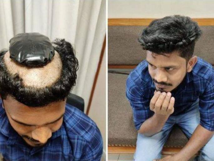Two smugglers arrested for hiding gold in hair wig | नकली केसांमधून सोनं तस्करी करणारे दोघे ताब्यात, हेअरस्टाइलने पोहोचवलं तुरूंगात! Two smugglers arrested for hiding gold in hair wig | नकली केसांमधून सोनं तस्करी करणारे दोघे ताब्यात, हेअरस्टाइलने पोहोचवलं तुरूंगात!