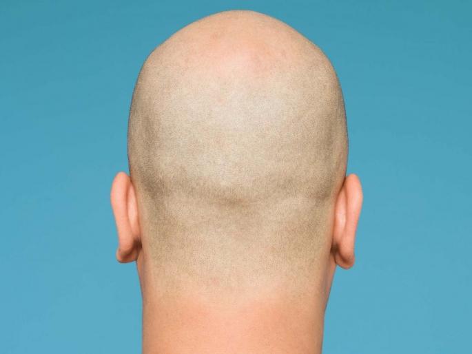 Bald men are up to 2-5 times more likely to suffer severe covid 19 says study/ | Corornavirus : टक्कल असलेल्या लोकांना कोरोनाचा जास्त धोका, अधिक गंभीर आजारी पडण्याचा रिसर्चमधून दावा Bald men are up to 2-5 times more likely to suffer severe covid 19 says study/ | Corornavirus : टक्कल असलेल्या लोकांना कोरोनाचा जास्त धोका, अधिक गंभीर आजारी पडण्याचा रिसर्चमधून दावा