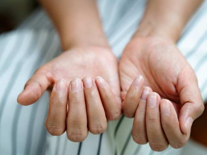 Most covid positive patients experience skin infection in second wave | COVID symptoms: नखे आणि त्वचेवर कोरोना कशाप्रकारे पसरवतोय इन्फेक्शन, वेळीच घ्या काळजी...