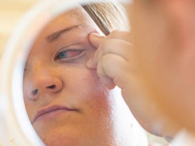 Hey surprise, something like nail glue in my eye ... | अहो आश्चर्यम, डोळ्यात घातला नेल ग्लु अन् झालं असं काही... Hey surprise, something like nail glue in my eye ... | अहो आश्चर्यम, डोळ्यात घातला नेल ग्लु अन् झालं असं काही...