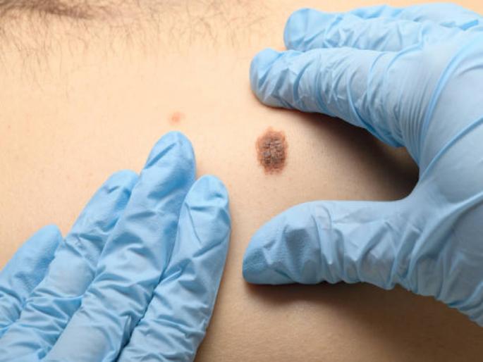 causes, symptoms remedies of melanoma cancer | तीळाचा बदलता आकार अन् रंग असु शकतं कॅन्सरचं लक्षण, वेळीच सावध व्हा! तज्ज्ञांचा सल्ला causes, symptoms remedies of melanoma cancer | तीळाचा बदलता आकार अन् रंग असु शकतं कॅन्सरचं लक्षण, वेळीच सावध व्हा! तज्ज्ञांचा सल्ला