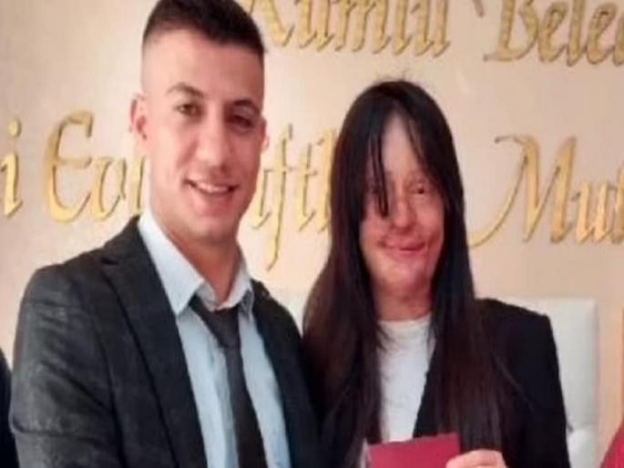 Turkey : The girl got married to the person who threw acid on her mouth | ज्याने चेहऱ्यावर फेकलं होतं अॅसिड, तरूणीने त्याच्यासोबतच केलं लग्न; सोशल मीडियावरून टिका Turkey : The girl got married to the person who threw acid on her mouth | ज्याने चेहऱ्यावर फेकलं होतं अॅसिड, तरूणीने त्याच्यासोबतच केलं लग्न; सोशल मीडियावरून टिका